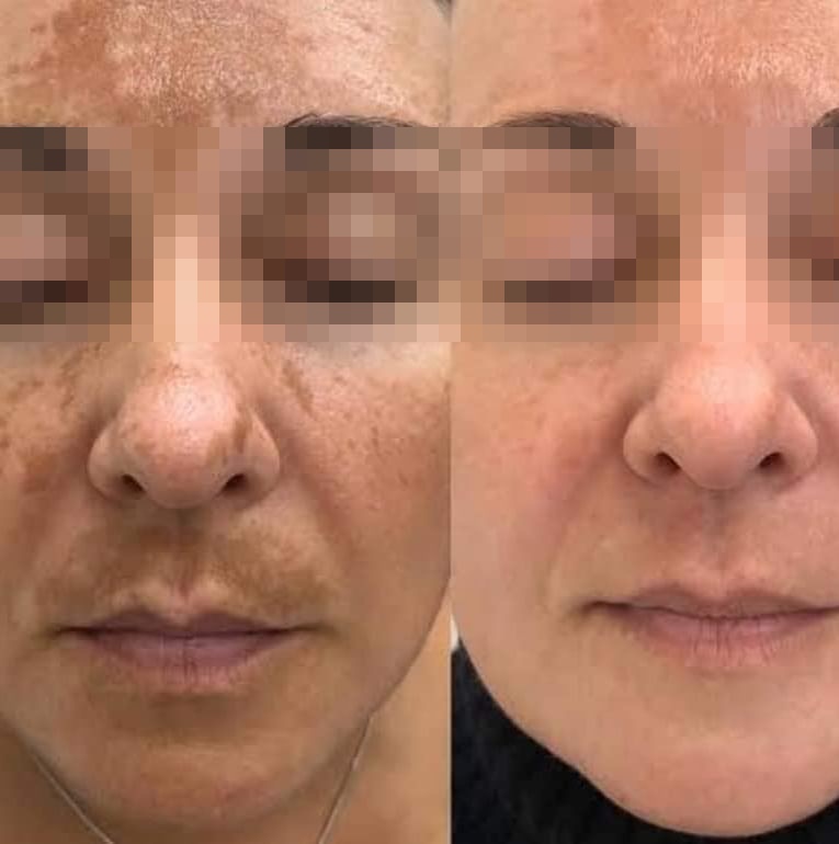 Ácido Glicólico: O Guia Completo para uma Pele Renovada