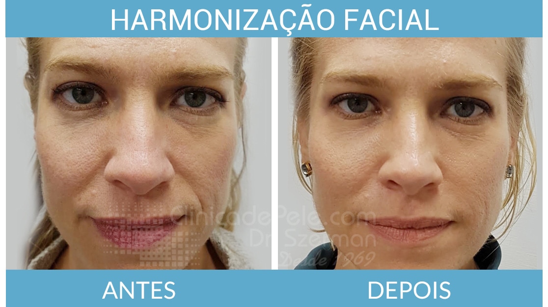 Melhores Cremes com Ácido Hialurônico para Cada Tipo de Pele