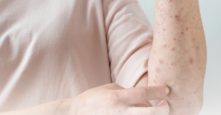 Alimentos Proibidos e Alternativas Seguras para Dietas Sem Glúten