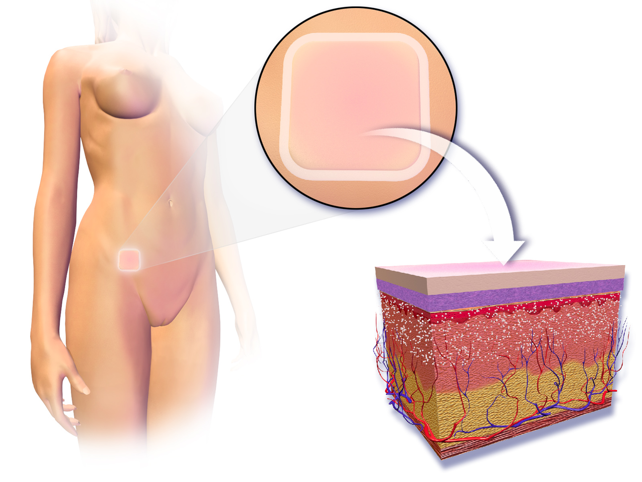 qual o preço do adesivo anticoncepcional