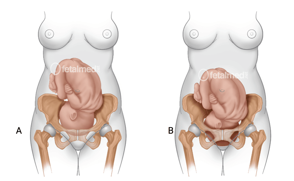 O que significa o bebê estar encaixado com 34 semanas?