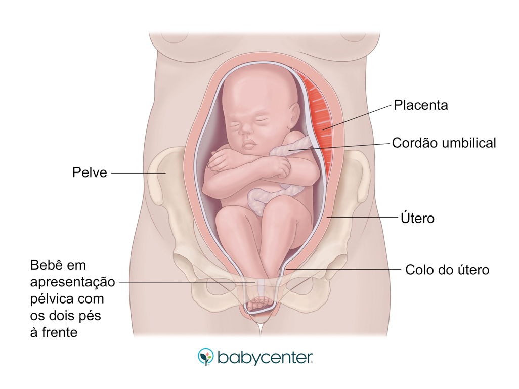 bebê pélvico tem algum problema
