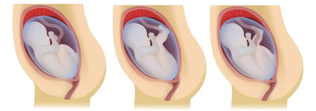 bebê pélvico tem algum problema