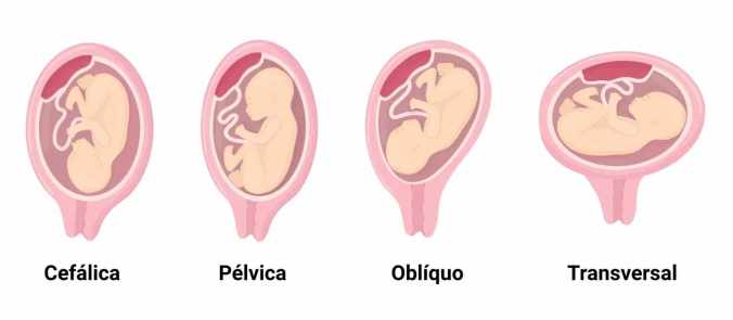 1. O Que Fazer Quando o Bebê Está Pélvico: Guia Completo
2. Displasia do Quadril: Entenda a Ligação com o Bebê Pélvico
3. Técnicas Seguras para Ajudar o Bebê a Virar na Gravidez
4. Parto Pélvico: Riscos e Alternativas para a Mamãe e o Bebê
5. Quando a Cesariana é a Melhor Opção para Bebê Pélvico?