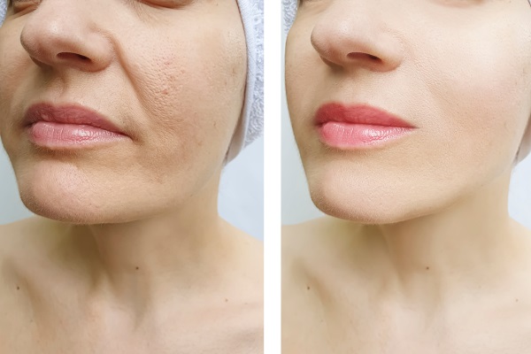 Ácido Hialurônico para Bigode Chinês: Guia Completo de Preenchimento