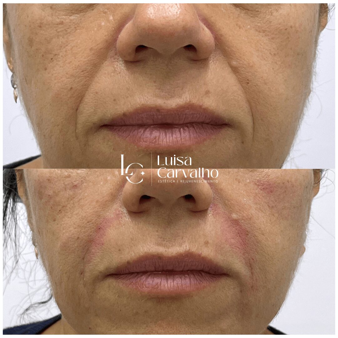 Bioestimuladores de Colágeno: A Solução para Flacidez e Bigode Chinês