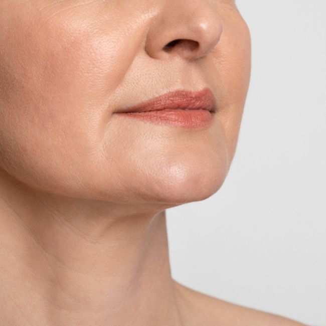 Ácido Hialurônico para Bigode Chinês: Guia Completo de Preenchimento