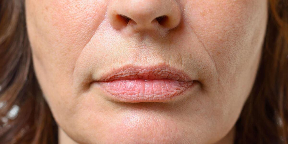 Bioestimuladores de Colágeno: A Solução para Flacidez e Bigode Chinês