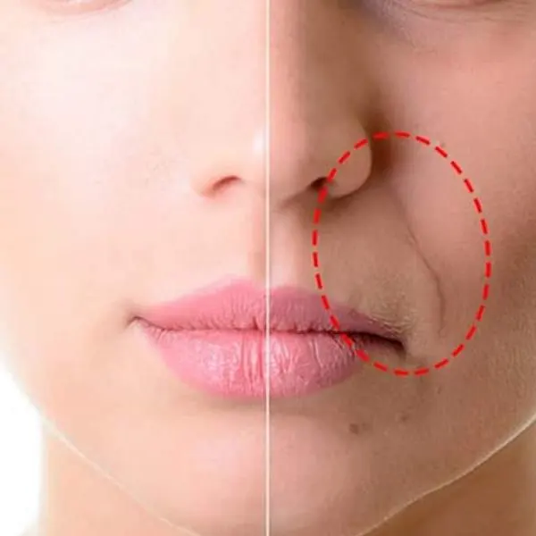 Prevenção do Bigode Chinês: Hábitos Essenciais e Dicas de Skincare