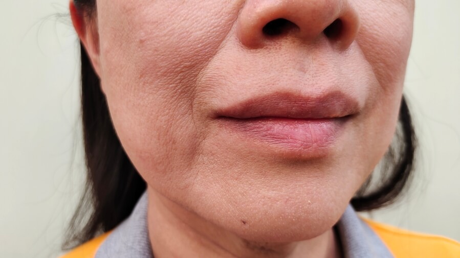 Bioestimuladores de Colágeno: A Solução para Flacidez e Bigode Chinês