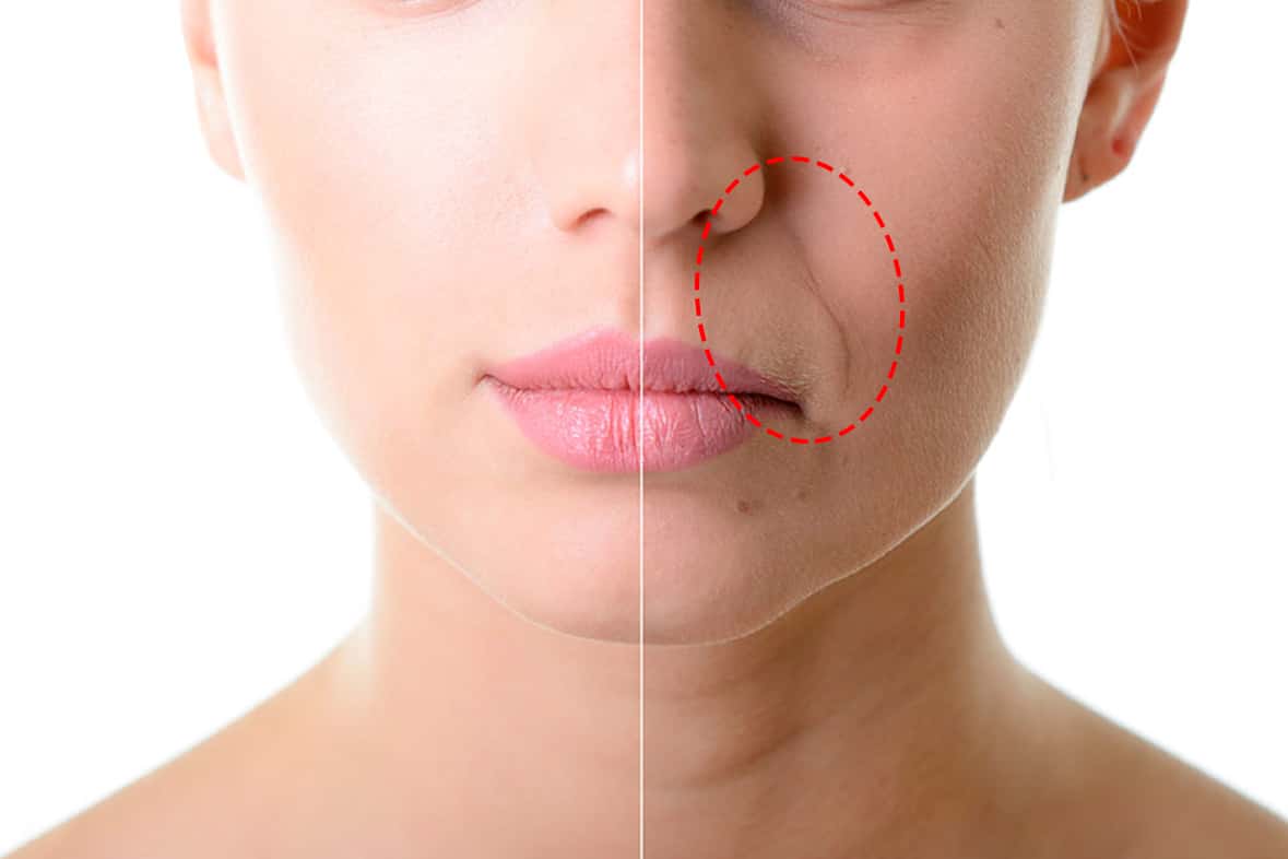 Prevenção do Bigode Chinês: Hábitos Essenciais e Dicas de Skincare