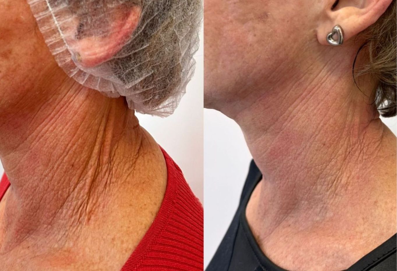 Bioestimulador de colágeno pescoço valor