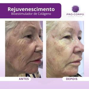 melhores bioestimuladores colágeno pescoço para rejuvenescer