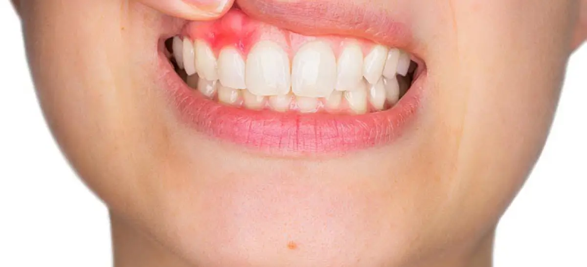 Mucocele e Rânula: Bolhas na Boca que Você Precisa Conhecer