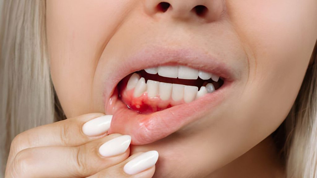 Como Manter a Higiene Bucal para Evitar Infecções na Gengiva