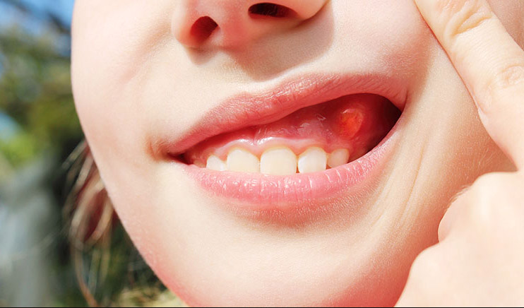 Abscesso Dentário: Sintomas, Causas e Tratamentos Eficazes