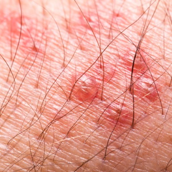 Sarna (Escabiose): Diagnóstico e Opções de Tratamento