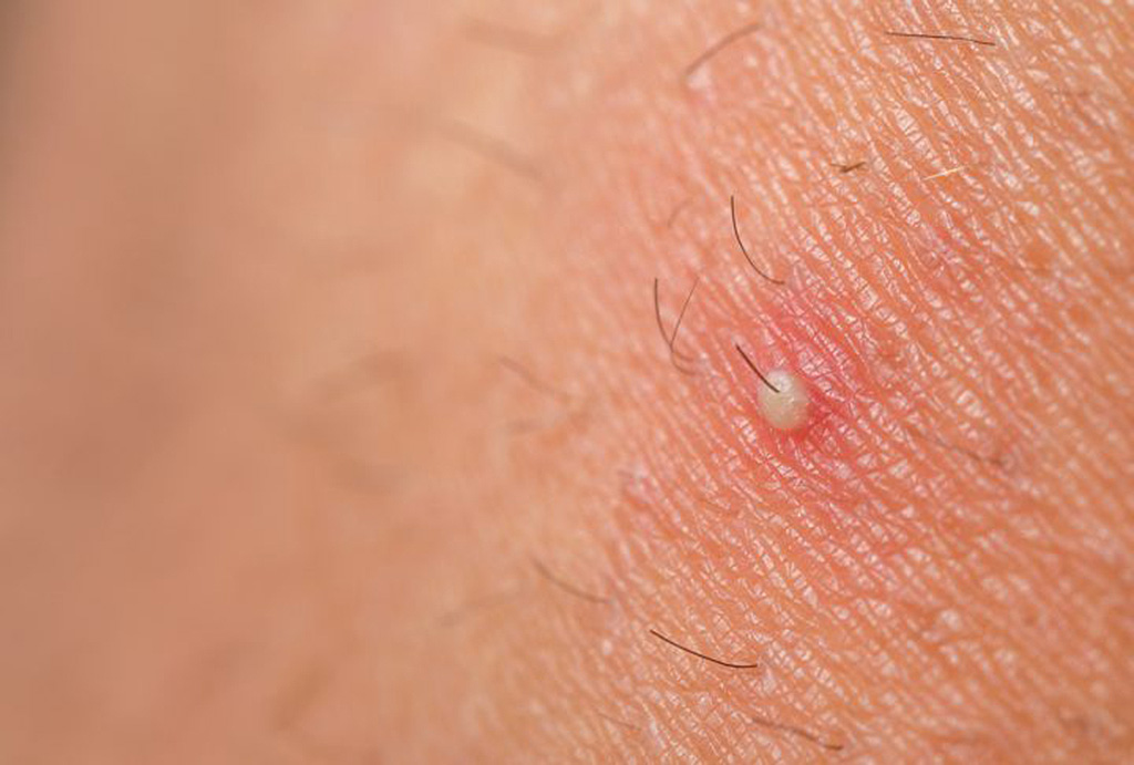 Como diferenciar Impetigo de Herpes Simplex?