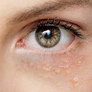 bolinhas em volta dos olhos