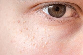 O que são Milia e como tratá-los?