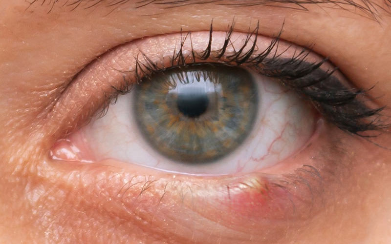 Terçol vs. Calázio: Conheça as diferenças