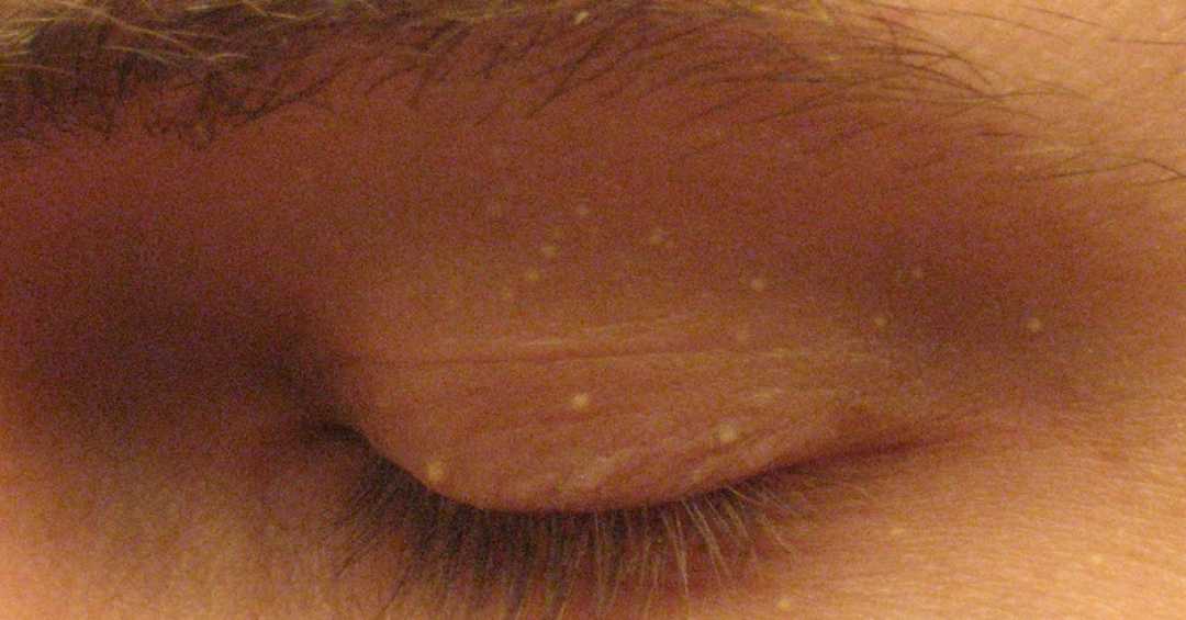 Molusco Contagioso: Sintomas e cuidados em crianças