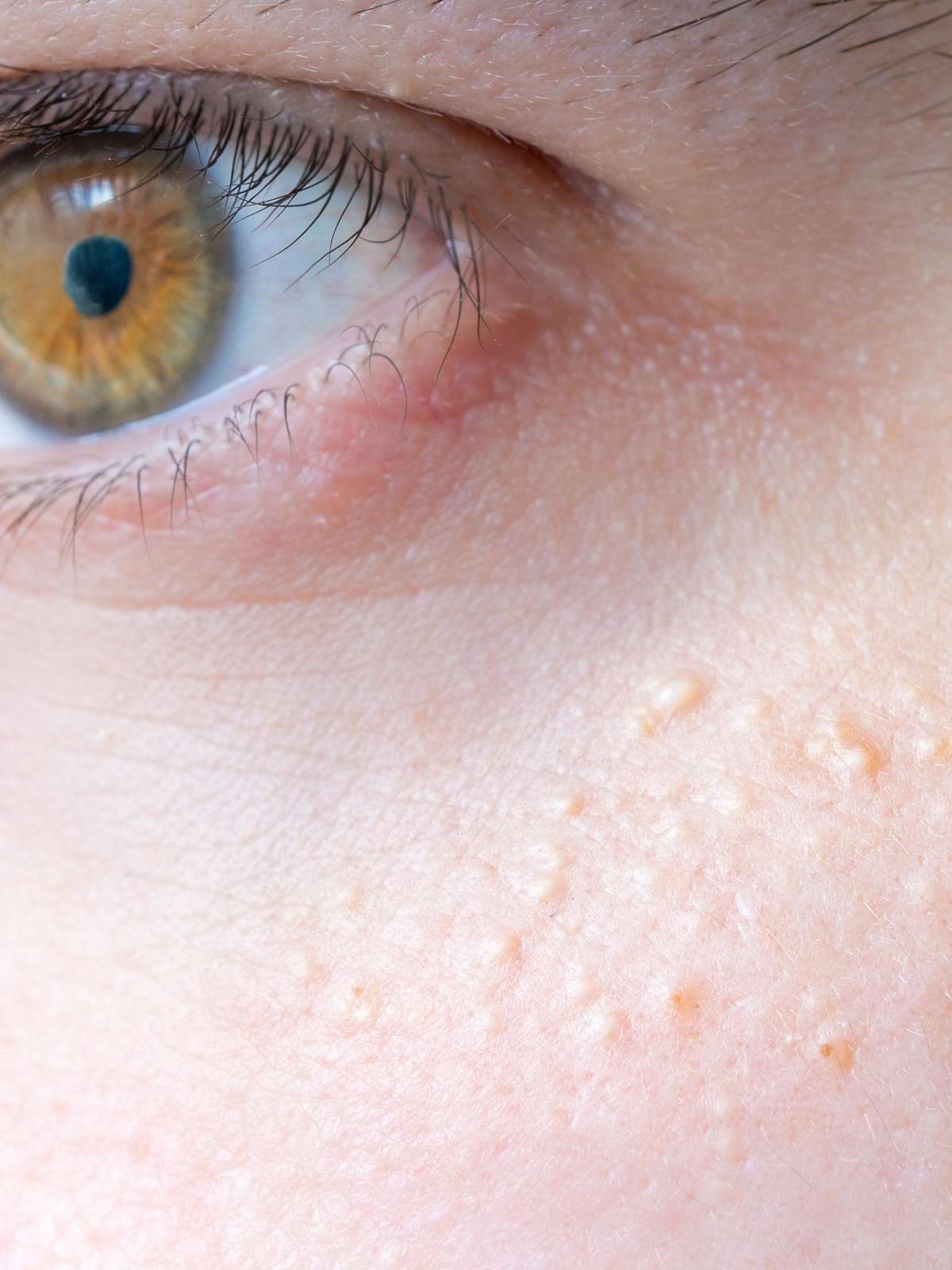 Siringoma: Entenda as causas e opções de tratamento