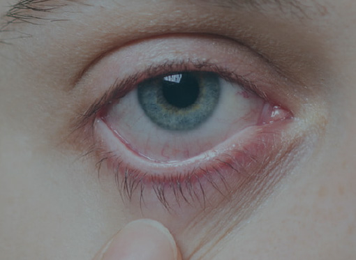 Xantelasma: Identificando e gerenciando depósitos de gordura