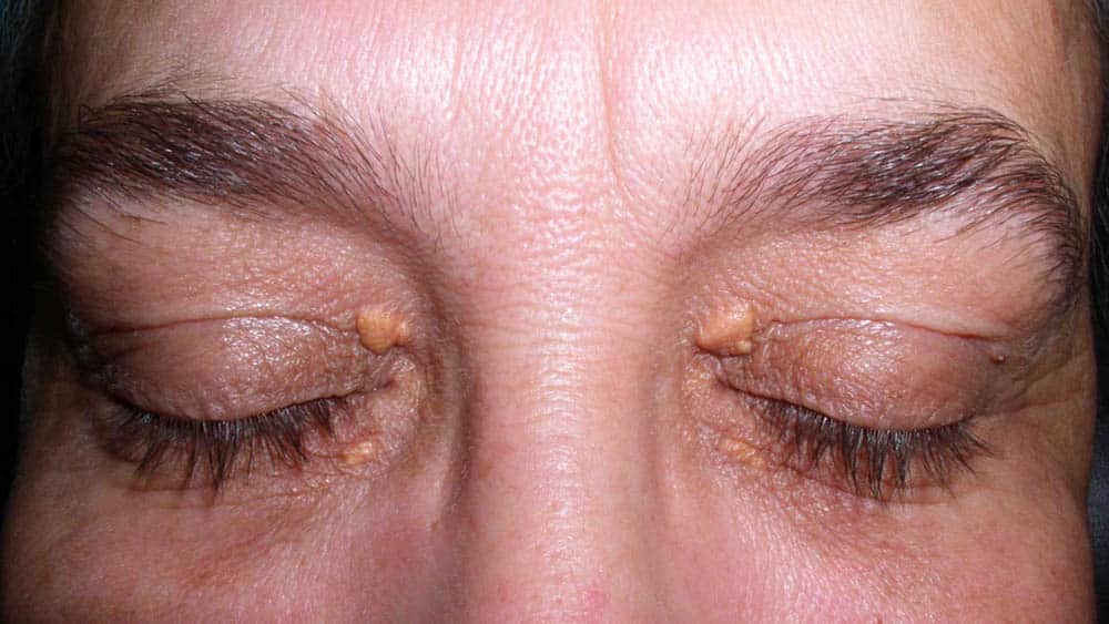 Terçol vs. Calázio: Conheça as diferenças