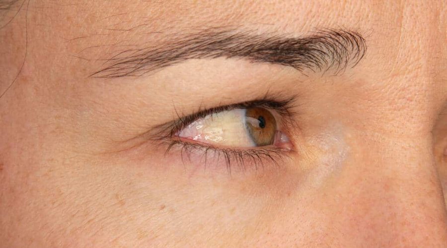 Molusco Contagioso: Sintomas e cuidados em crianças