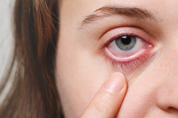 O que são Milia e como tratá-los?