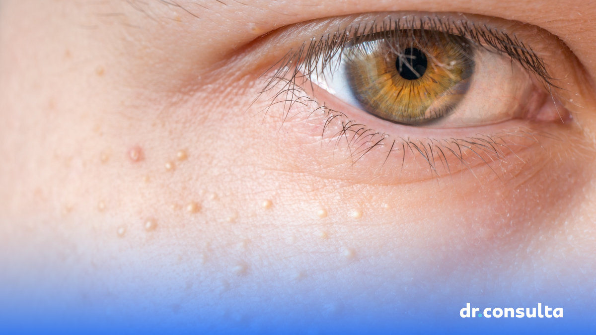 Siringoma: Entenda as causas e opções de tratamento