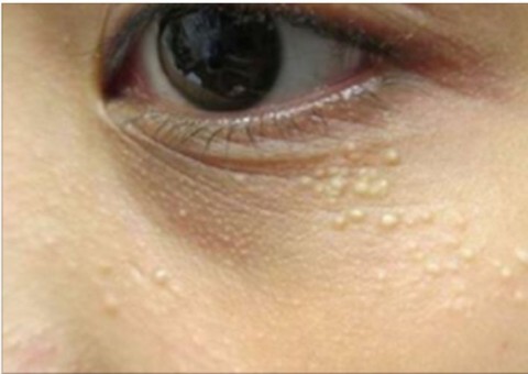 Terçol vs. Calázio: Conheça as diferenças