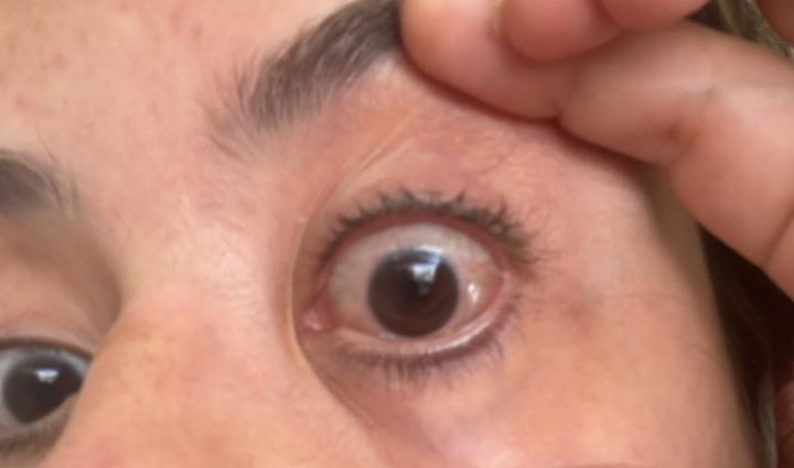 Molusco Contagioso: Sintomas e cuidados em crianças