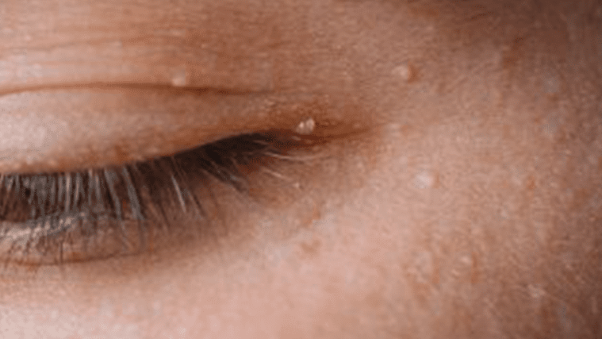 Terçol vs. Calázio: Conheça as diferenças