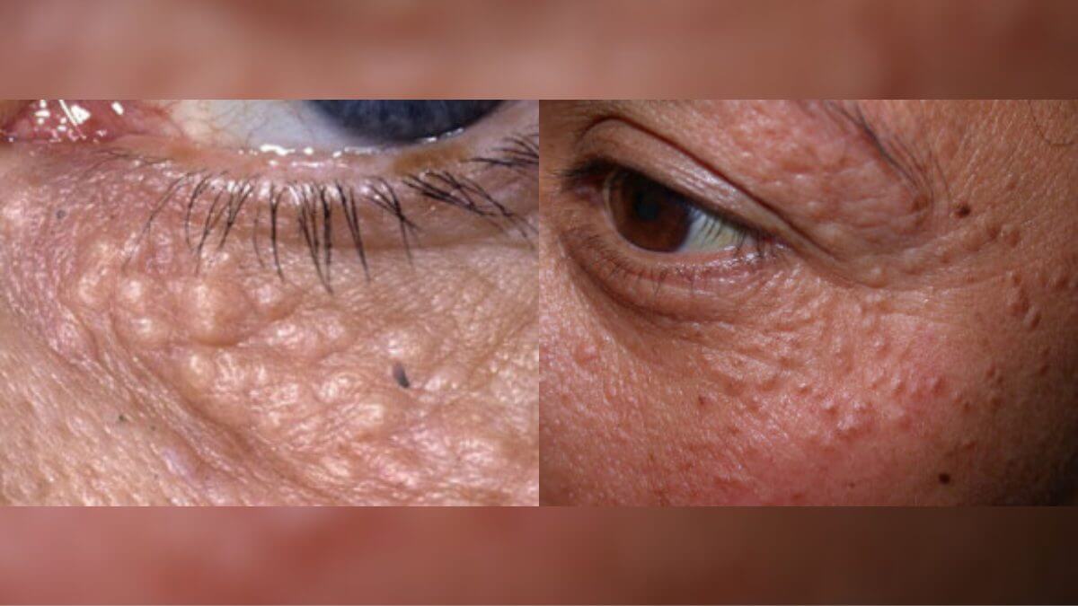 Molusco Contagioso: Sintomas e cuidados em crianças