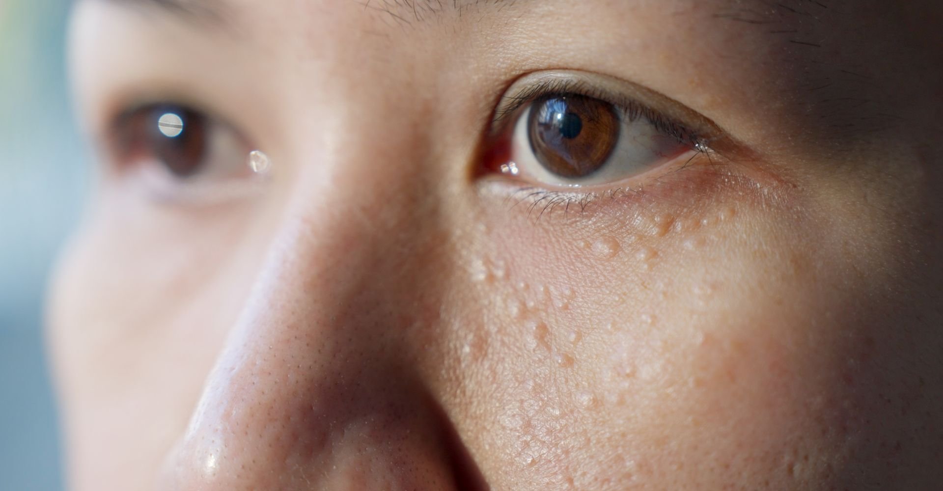 Xantelasma: Identificando e gerenciando depósitos de gordura