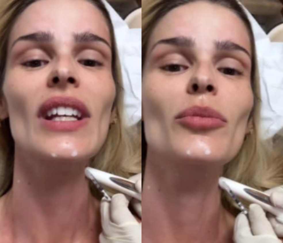 Botox no pescoço efeito nefertiti valor