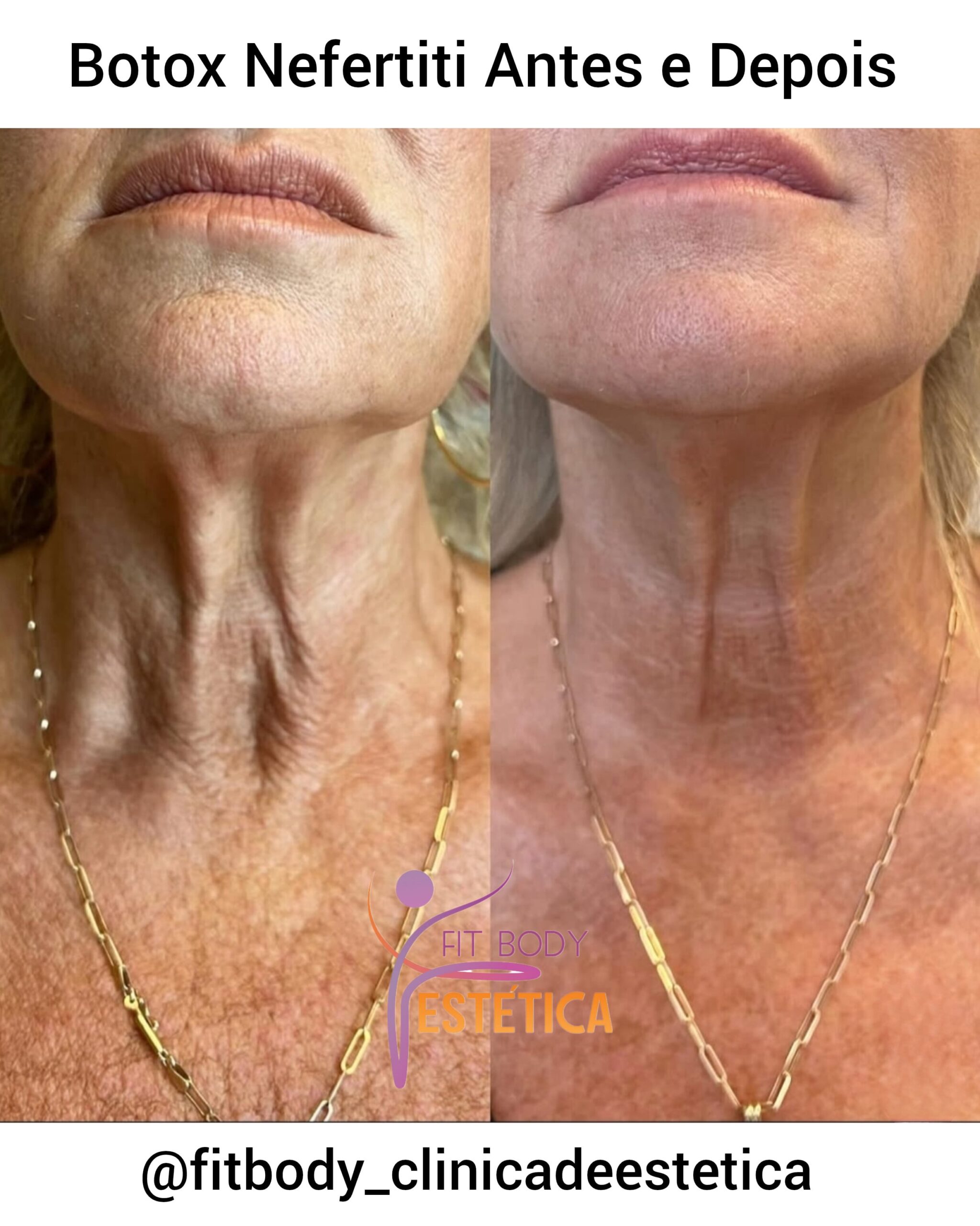 melhores clínicas botox pescoço efeito nefertiti