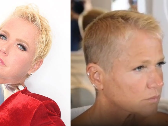 Alopecia Androgenética: O que é e como Xuxa lida com a condição