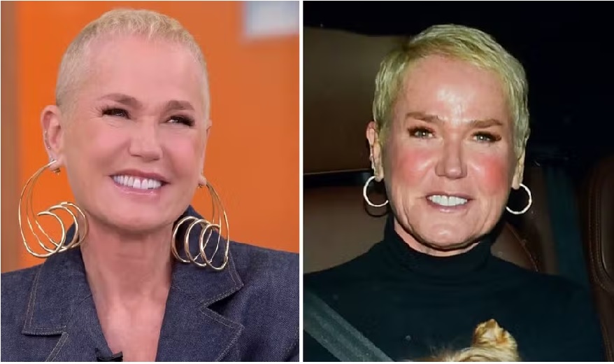 Xuxa e a Calvície Feminina: Um incentivo para buscar diagnóstico e tratamento