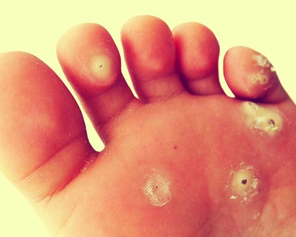 Guia Completo: Como Escolher o Calçado Ideal para Evitar Calos; Calo Mole vs. Calo Duro: Entenda as Diferenças e o Melhor Tratamento; Hidratação e Proteção: Os Melhores Produtos para Prevenir Calosidades; Quando Procurar um Podólogo para Tratar Calos Persistentes?; Mitos e Verdades sobre Calicidas e o Tratamento Caseiro de Calos