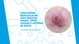 cancer de pele na virilha