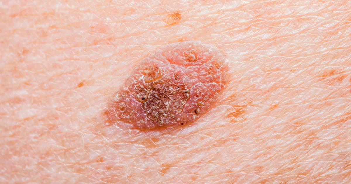 O que é a regra do ABCDE para sinais? Entenda os tipos de câncer de pele. Como a cirurgia trata o câncer de pele? A importância do dermatologista no diagnóstico precoce. Radioterapia e quimioterapia no câncer de pele.