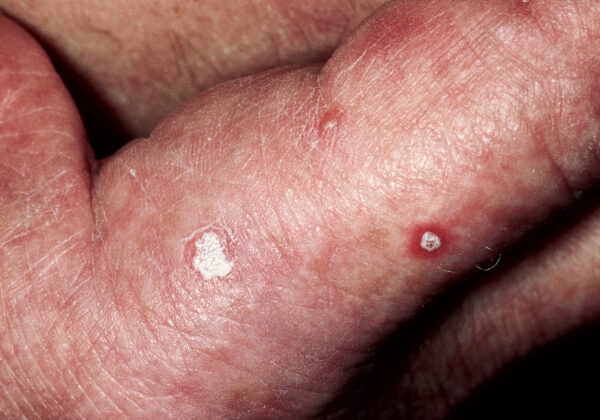 cancer de pele na virilha