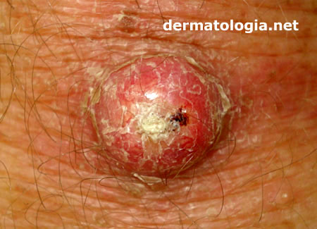 O que é a regra do ABCDE para sinais? Entenda os tipos de câncer de pele. Como a cirurgia trata o câncer de pele? A importância do dermatologista no diagnóstico precoce. Radioterapia e quimioterapia no câncer de pele.