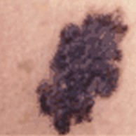 O que é a regra do ABCDE para sinais? Entenda os tipos de câncer de pele. Como a cirurgia trata o câncer de pele? A importância do dermatologista no diagnóstico precoce. Radioterapia e quimioterapia no câncer de pele.