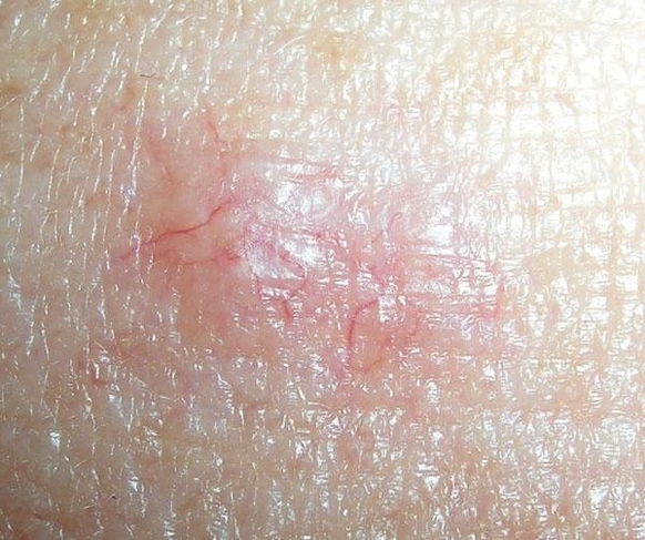 cancer de pele na virilha