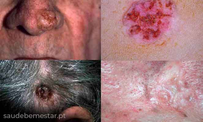 O que é a regra do ABCDE para sinais? Entenda os tipos de câncer de pele. Como a cirurgia trata o câncer de pele? A importância do dermatologista no diagnóstico precoce. Radioterapia e quimioterapia no câncer de pele.