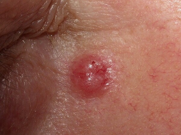 cancer de pele na virilha